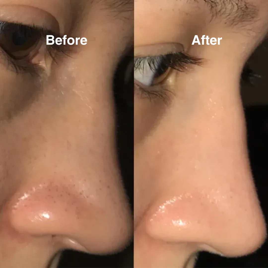 imgi_99_glowfacial-beforeafter2
